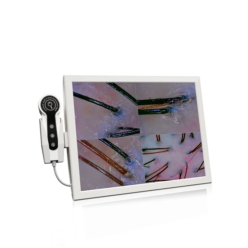 High Quality Portable HD Screen Withered Hair Loss Detector Scalp scanner Hair Analyzer / Skin And Hair Analysis 152A