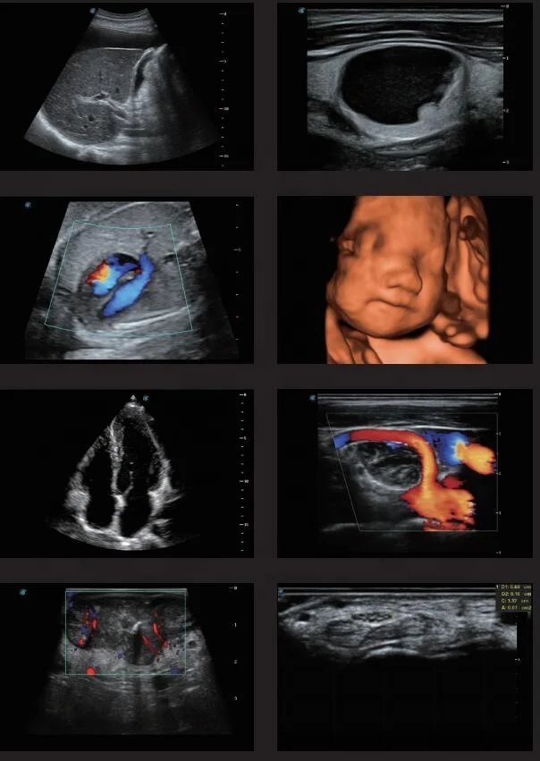 SonoScape  A5 Ultrasound /Ultrasound Diagnosis Digital Color Doppler Ultrasound Machine Price