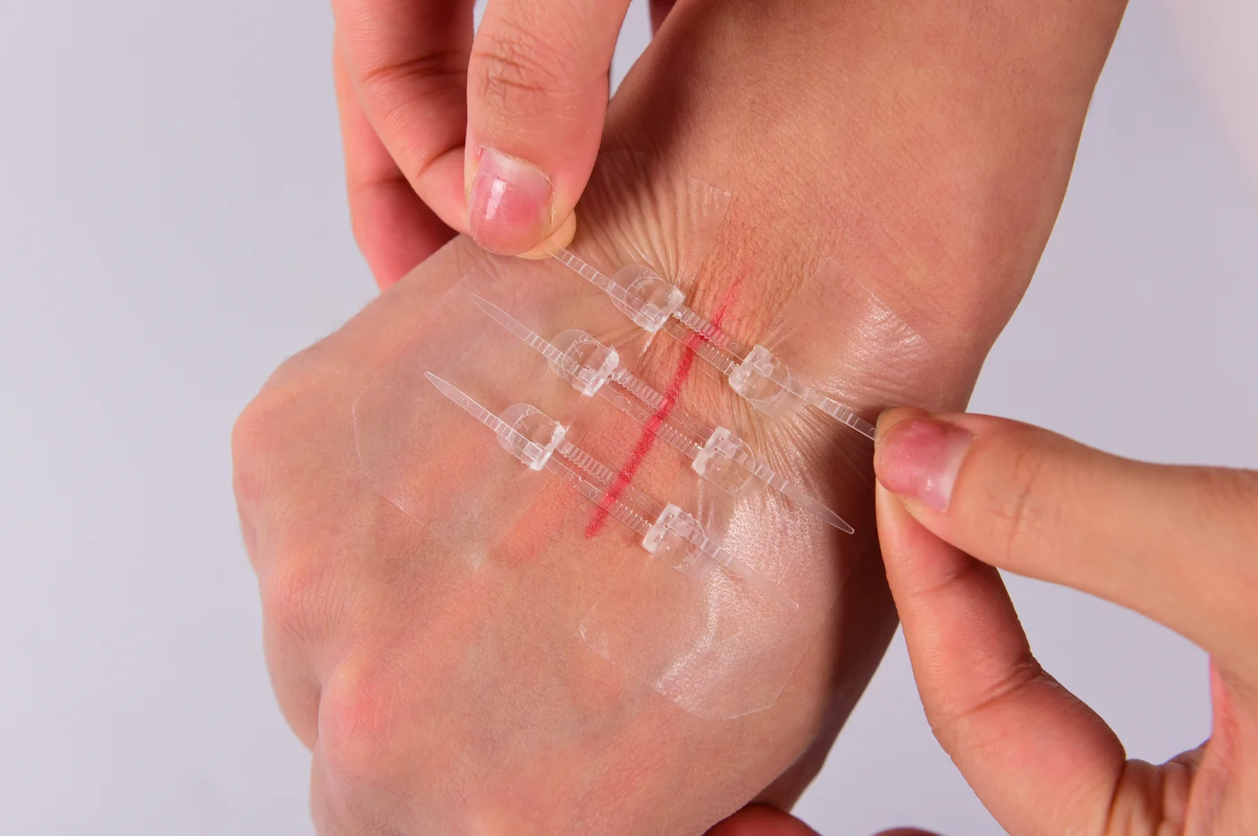 Medical Sterile Skin Closure Device Noninvasive Zip Without Stitches Sterile Strips Without Threads Dressing Wound Closure Strip