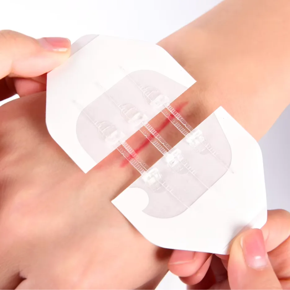 Medical Sterile Skin Closure Device Noninvasive Zip Without Stitches Sterile Strips Without Threads Dressing Wound Closure Strip