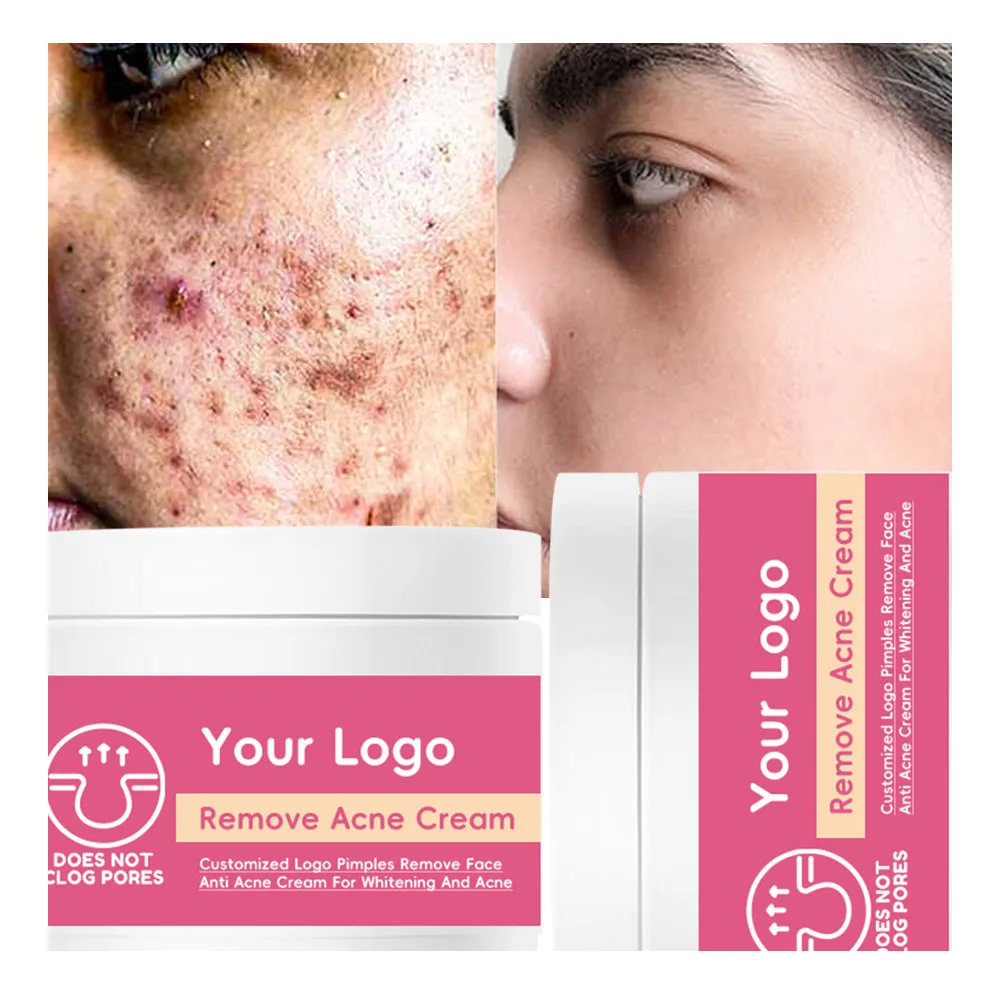 Benzoyl Peroxide Topical Pimple Cream Acne for Face Targets Blemishes Reduces Redness Calms Clears