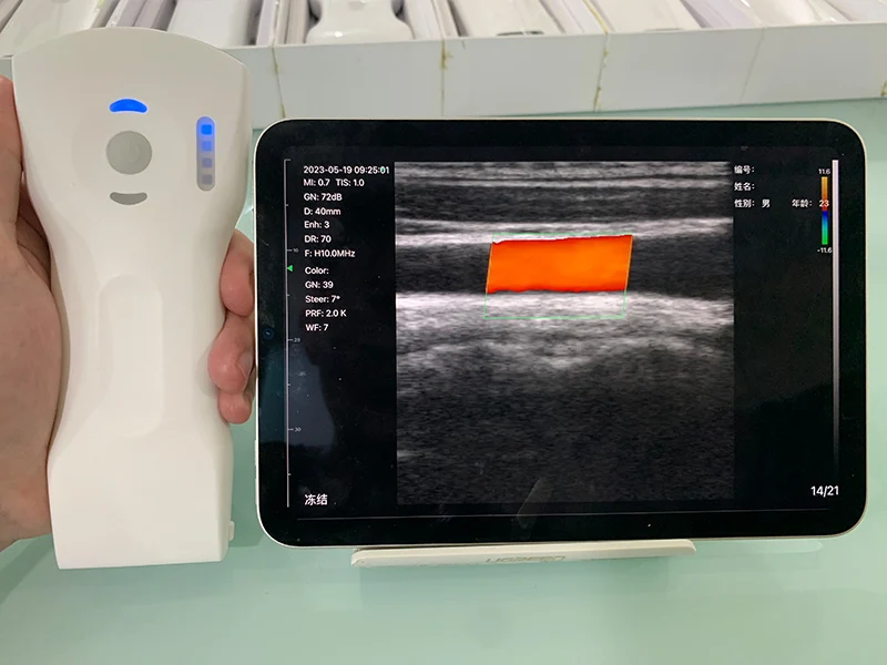 Suresult Eagle View Portable And Sonostar Uprobe C4PL Wireless Ultrasound Scanner Available On Global Digital Export Platform