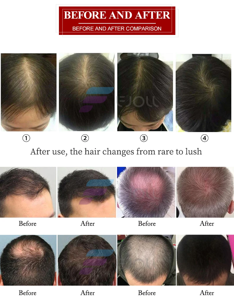 Factory wholesale Red Light Therapy laser Hair Regrowth  For Hair Growth Alopecia Areata Treatment