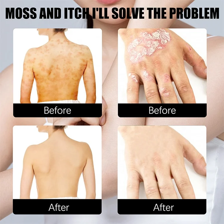 Hot Selling 100G Soothe Psoriasis Eczema Care Body Lotion Improve Dry Itchy Sensitive Skin Repair moisturizing