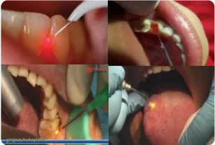 980nm 15w dental laser machine diode laser with treatment handpiece dental equipments