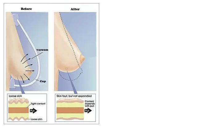Enhance Breast Enlargement scraping cupping Beauty Machine / butt lifting machine / massaging equipment for health AB608