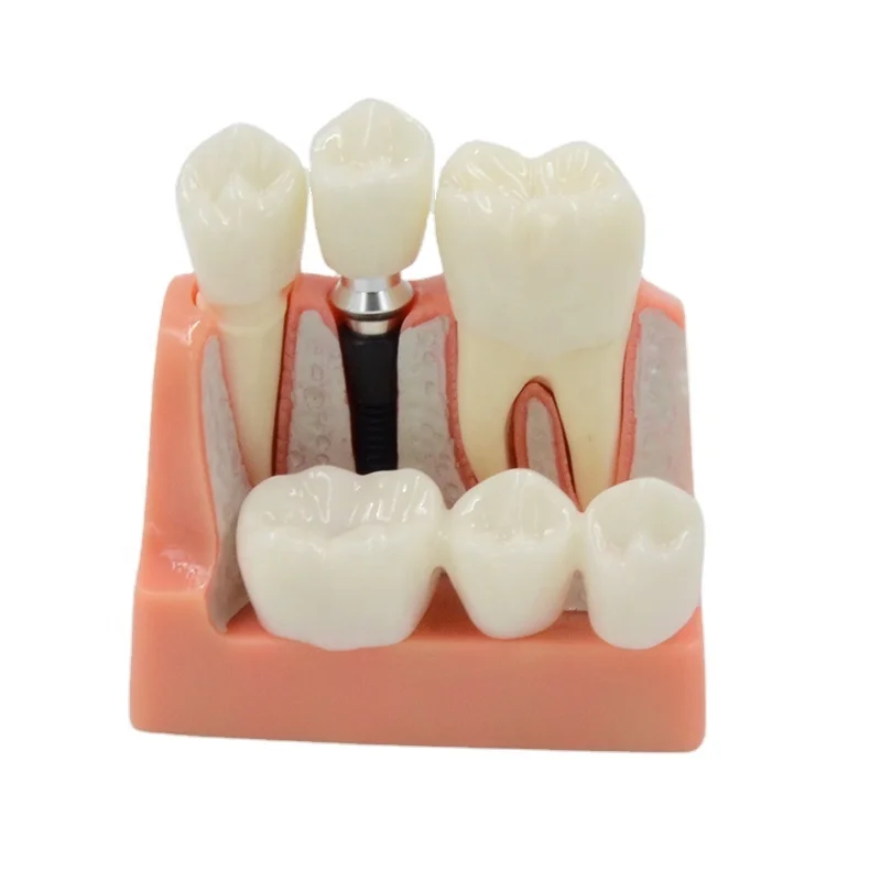 Модель зубного импланта, образовательная модель зубов
