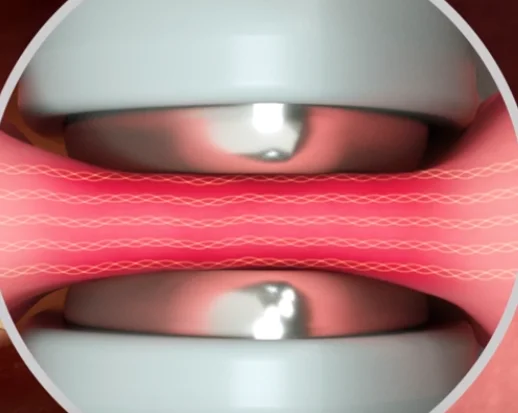 5mm LigaSure Emerald System Vessel Sealing