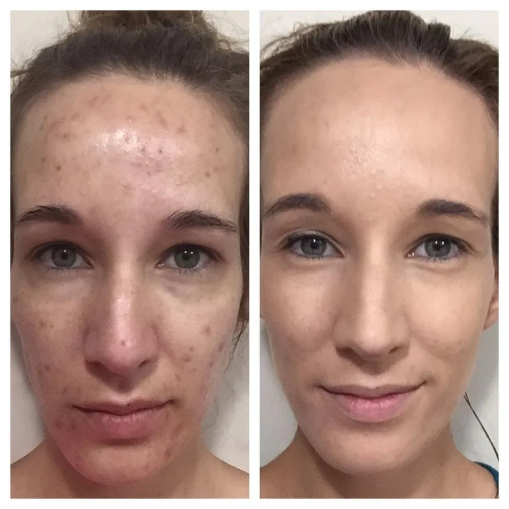 wholesale whitening pimples acne scar treatment freckle dark spot corrector removing fade cream