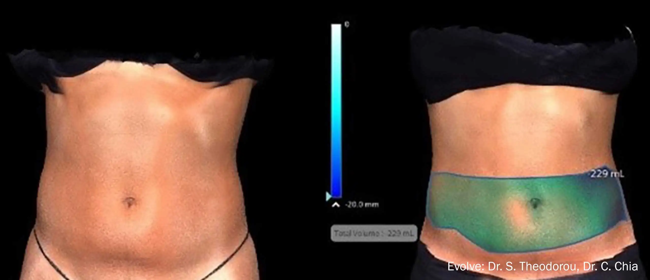 Оборудование для похудения