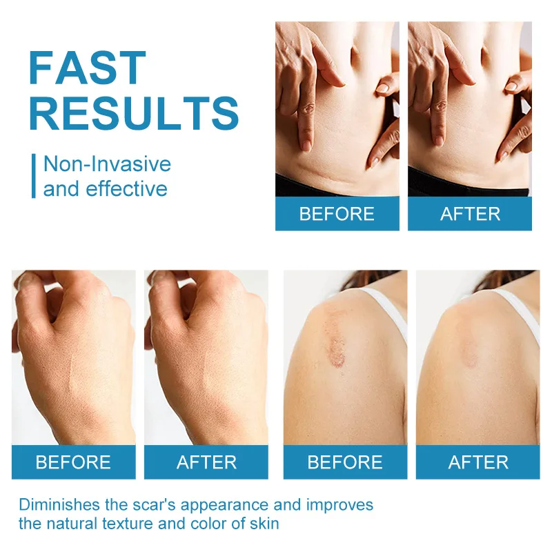 Medical-grade silicone dressing scar removal Patch Self-adhesive scar repair tape patch