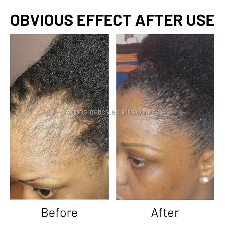 OEM Smoothing Anti Hair Loss Batana Oil For Hair Growth Batana Oil Butter Scalp Treatment Batana Oil Hair Mask