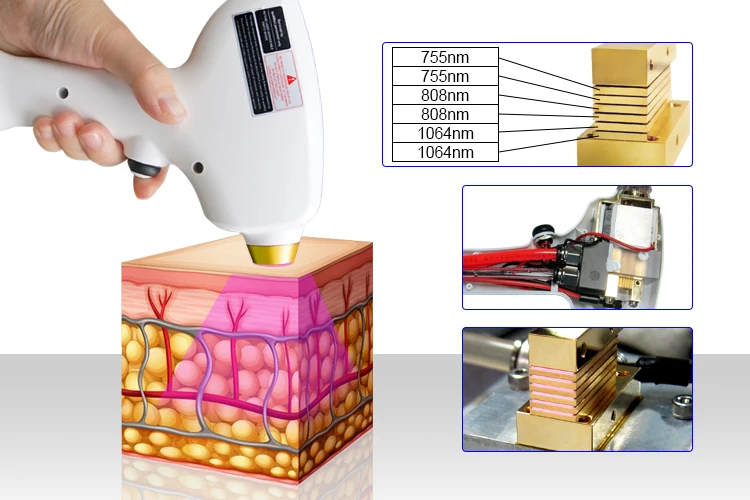 Laser hair removal 755nm 808nm 1064nm permanent diode hair removal laser diode laser 755 808 1064