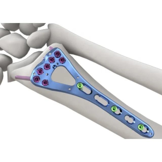 Дистальный радиус и пластинчатый травматовый имплантат Ulna