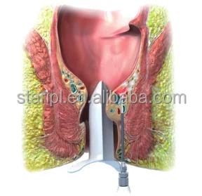 Medical Hemorrhoids Laser Machine 980nm 1470nm Diode Laser Germany Urology Laser Fistula Surgery Device Rectal Proctology