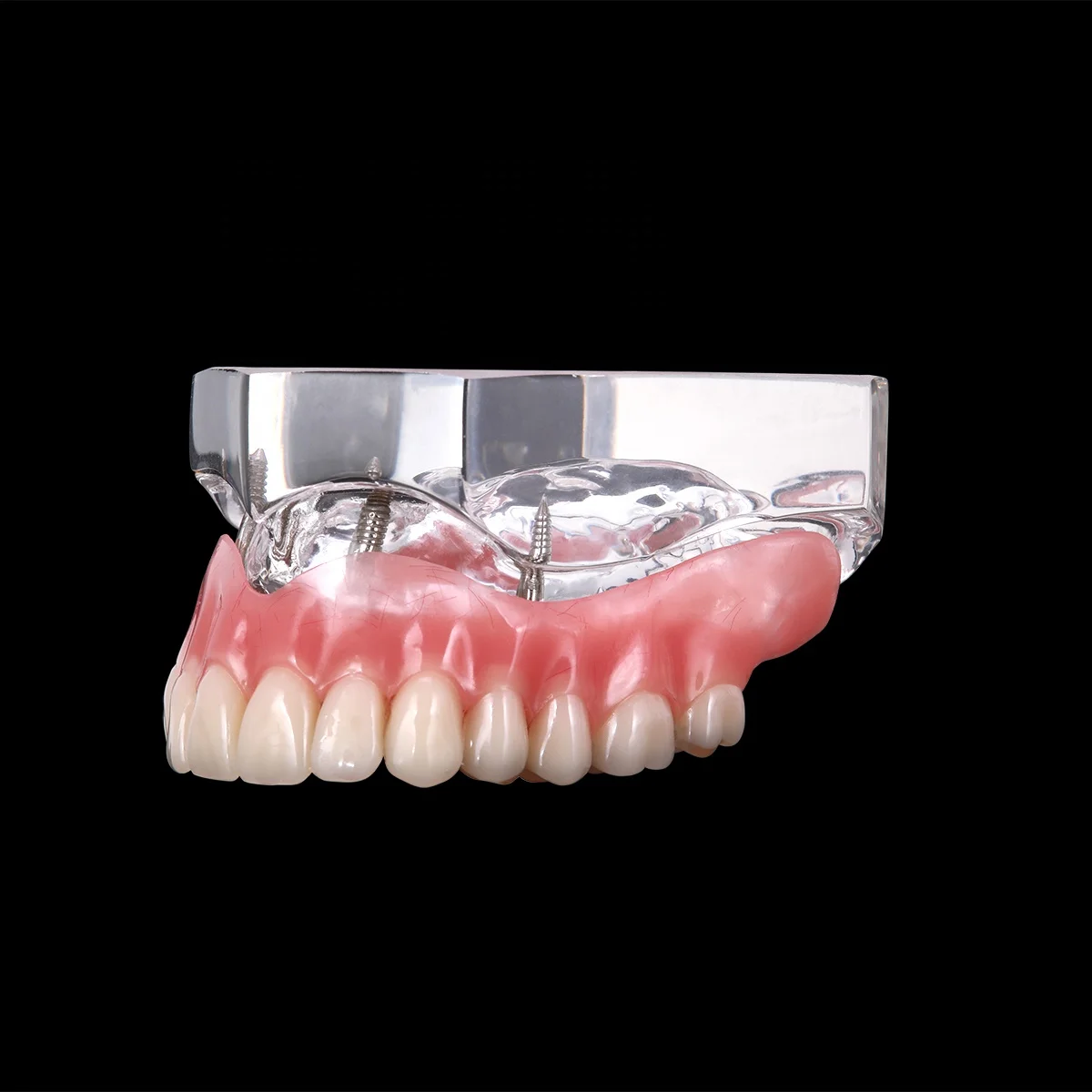 Hot Selling Dental Implant Teeth Model Overdenture Restoration with Implants Upper
