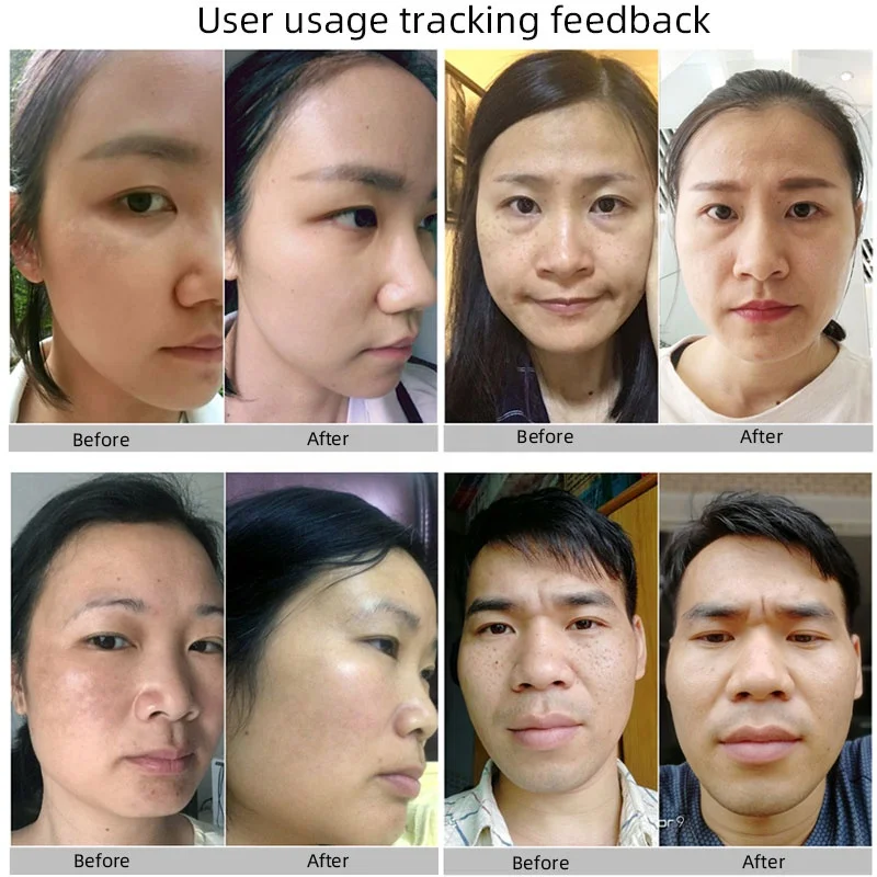 OEM face body armpit elbows knees sensitive areas hyperpigmentation whitening treatment freckle blemish dark spot removing cream