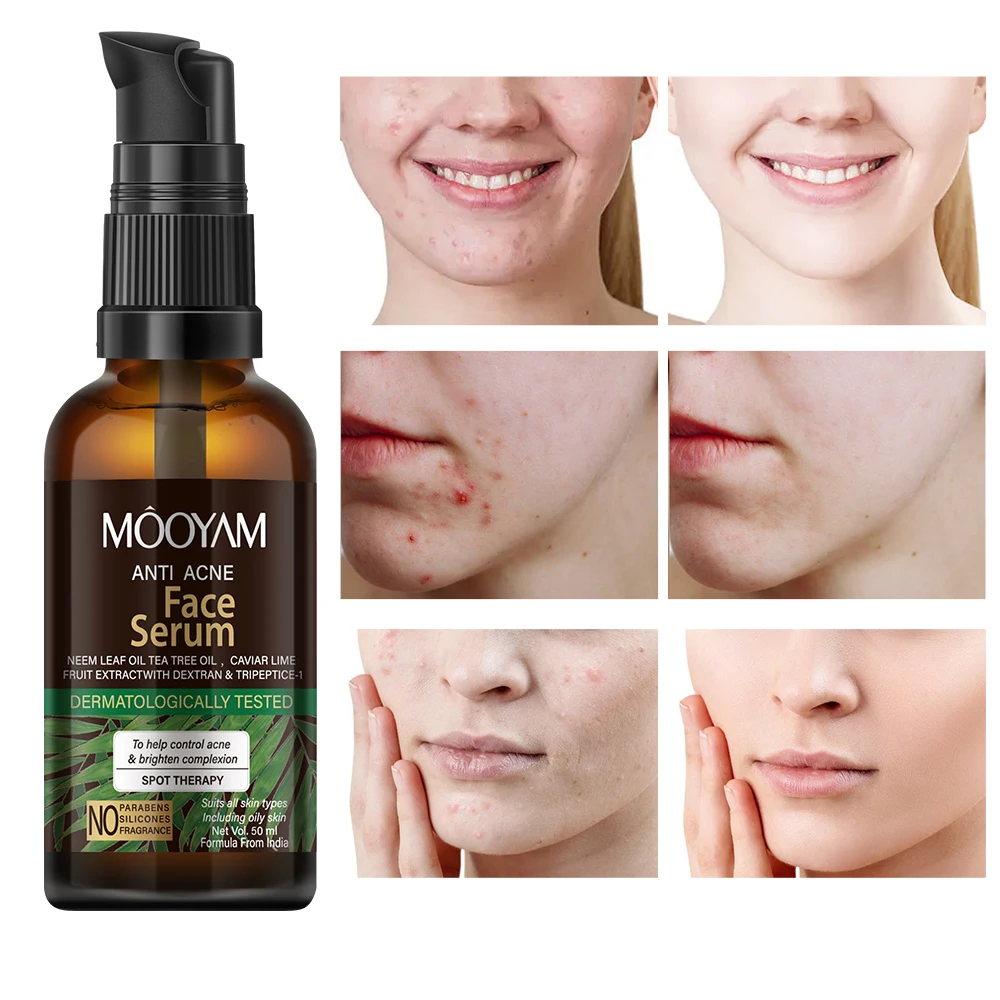 Facial Serum Lighten Old and New Acne Marks Relieve Redness Swelling and Acne Balancing oils 50ml MOOYAM Anti Acne Face Serum