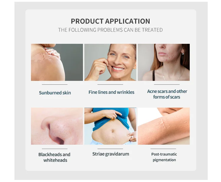 Портативная система всасывания СКРАБА с насосом 2022 Ultrapeel Pepita Machine палочки для