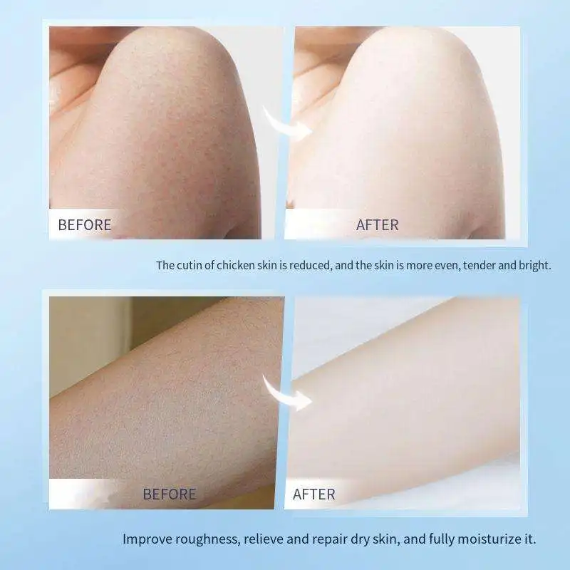 OEM Vitamin E Carbamide Face Body Cream Non-Irritating Keratin Exfoliate Chicken Skin Remover Foot Urea and Vitamin E Cream