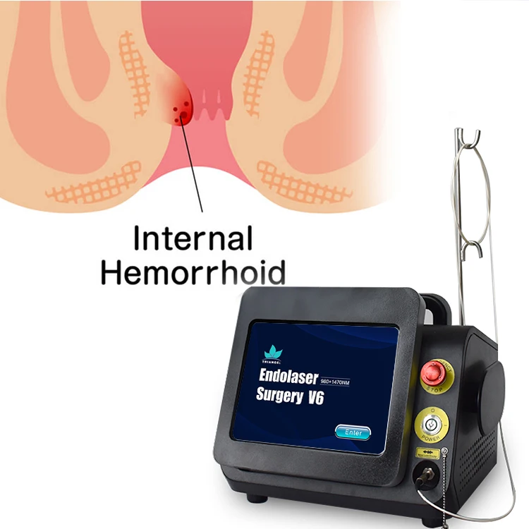 Super supplier 980nm 1470nm  diode laser hemorrhoids machine for proctoloy