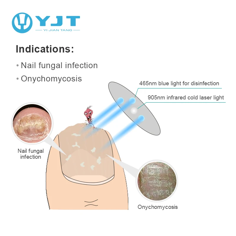 Care Nail Fungus Cold Laser Treatment Device Toe Removal Infrared 905nm Onychomycosis Podiatry Medical Instrument