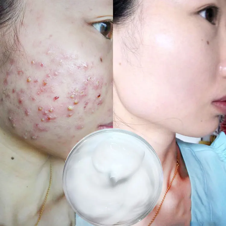 
Face Tea Tree Pimples And Dark Spot Removal Salicylic Acid Anti Scar Best Pimple Remove Acne Cream 