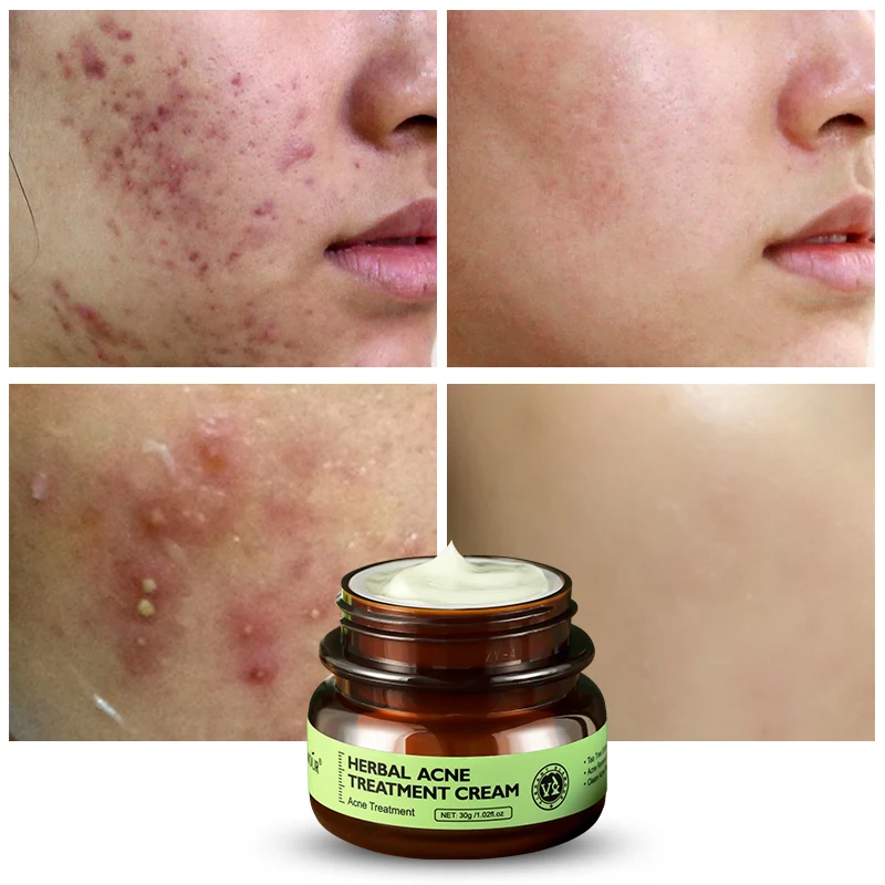 VIBRANT GLAMOUR Herbal Acne Treatment Cream Oil Control Brighten Nourish Whitening Shrink Pores Remove Scars Marks Skin Care30g