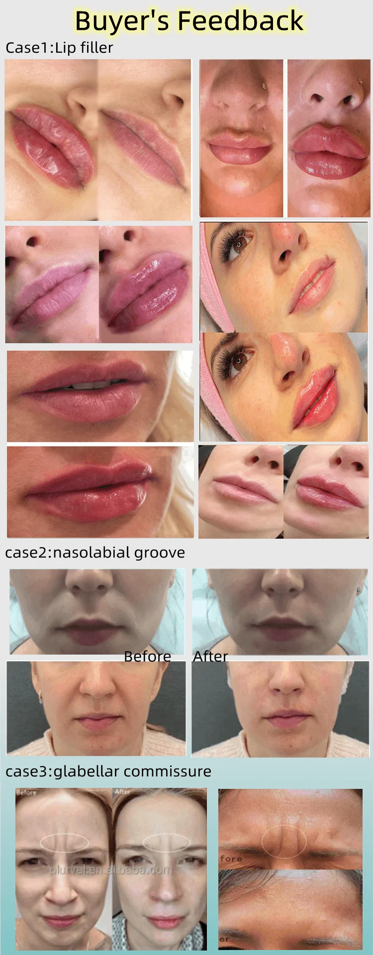 Premium Lip Filler - Transform Your Lips Instantly