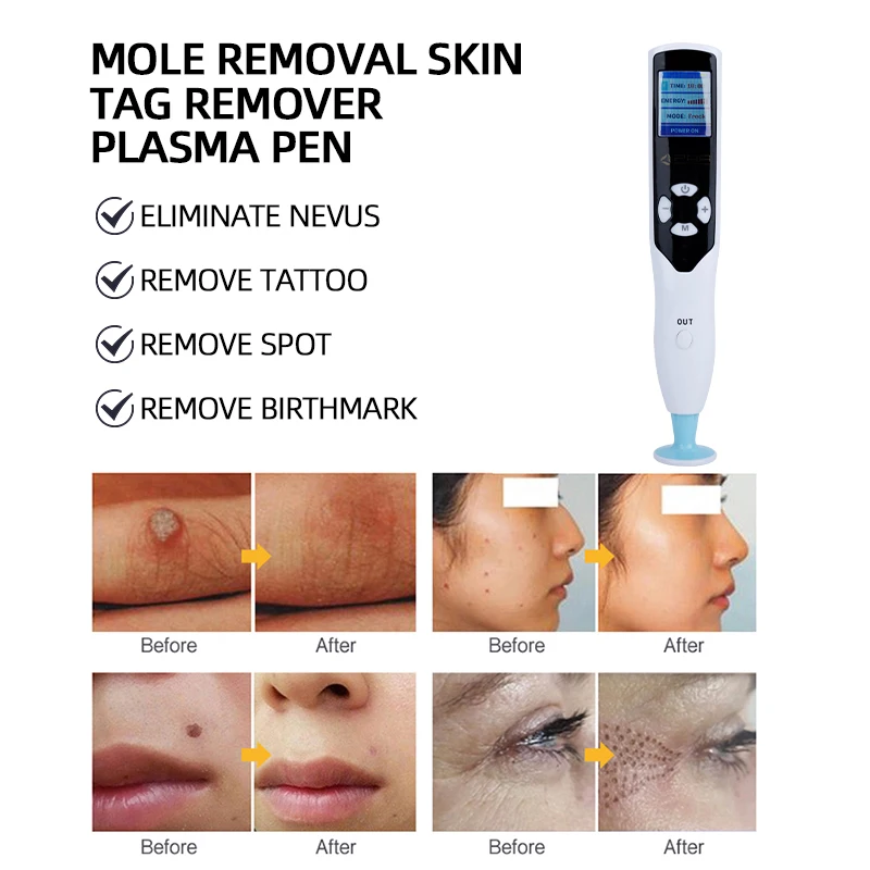Spot Removal Plasma Mole Remover Pen Portable 2 in 1 Plasma Ozone Pen