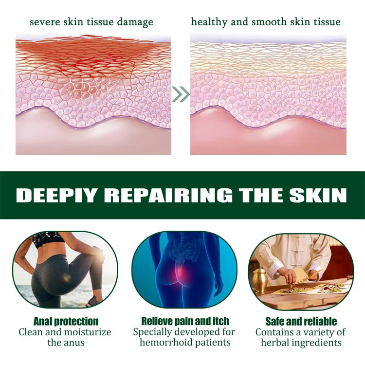 New Arrival Healthy Product Hemorrhoid Ointment No Harmful Addition Mild Non-irritation Hemorrhoid Cream