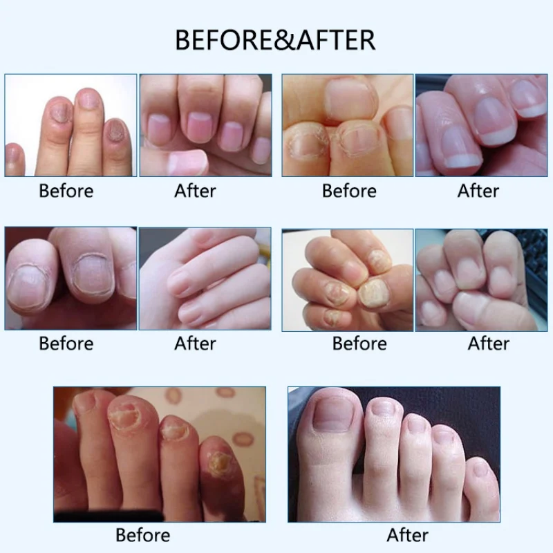 Nail Treatment From Fungus on Feet and Hand Disinfection Nail Fungal Treatment Oil Pen Manicure Treatment Tools