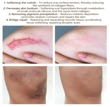 Acne Scar Removal Gel Treatment Surgical Scald Repair Cream Fade Dark Skin Pigmentation Postpartum Whitening Smooth Skin Care