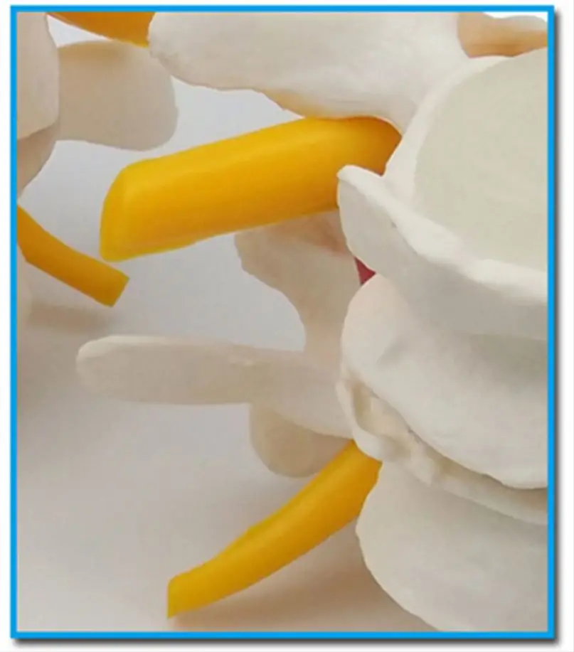 
The diseased model of vertebrae 