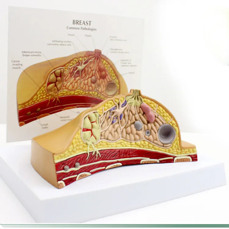 Pathological models of the breast on the anatomy of medical diseases and cancers Models of the female breast