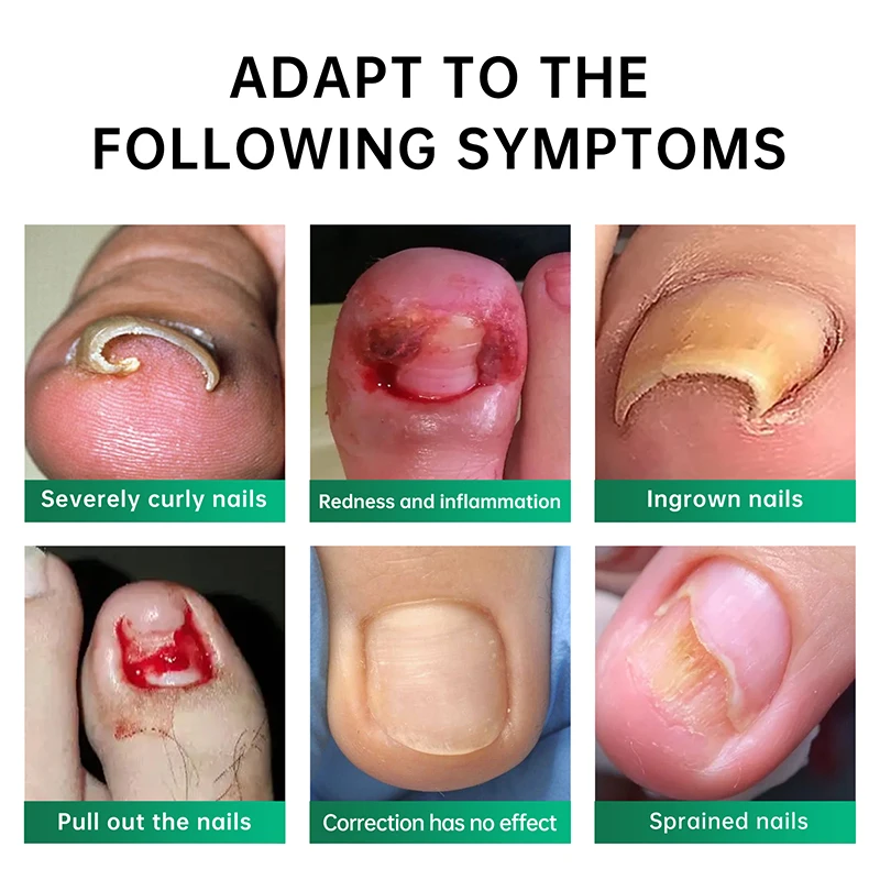 Private Label Nail Treatment Oil Anti Infection Paronychia Onychomycosis Feet Care Nail Fungus Removal Gel Care