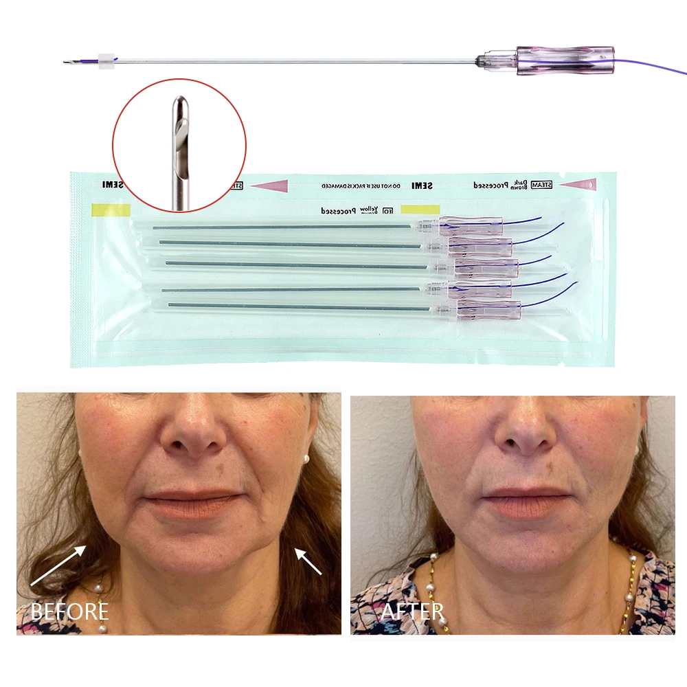 Strong Jawline Face Lift L Blunt Needle 18g 100mm Whale Teeth Cog Molding Pdo Thread