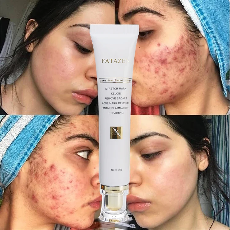 Strong Effective Acne Scar Removal Cream Pimples Stretch Marks Remove Face Gel Tummy Tuck Tightening Stretch Mark Removal Cream