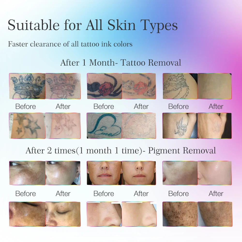Winkonlaser EL500 Picoking Portable Pico Laser Tattoo Removal Picosecond Machine For Sale