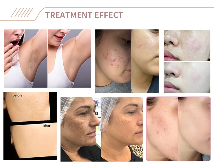 weifang huamei ipl EROSE-B3 HM-IPL-B3