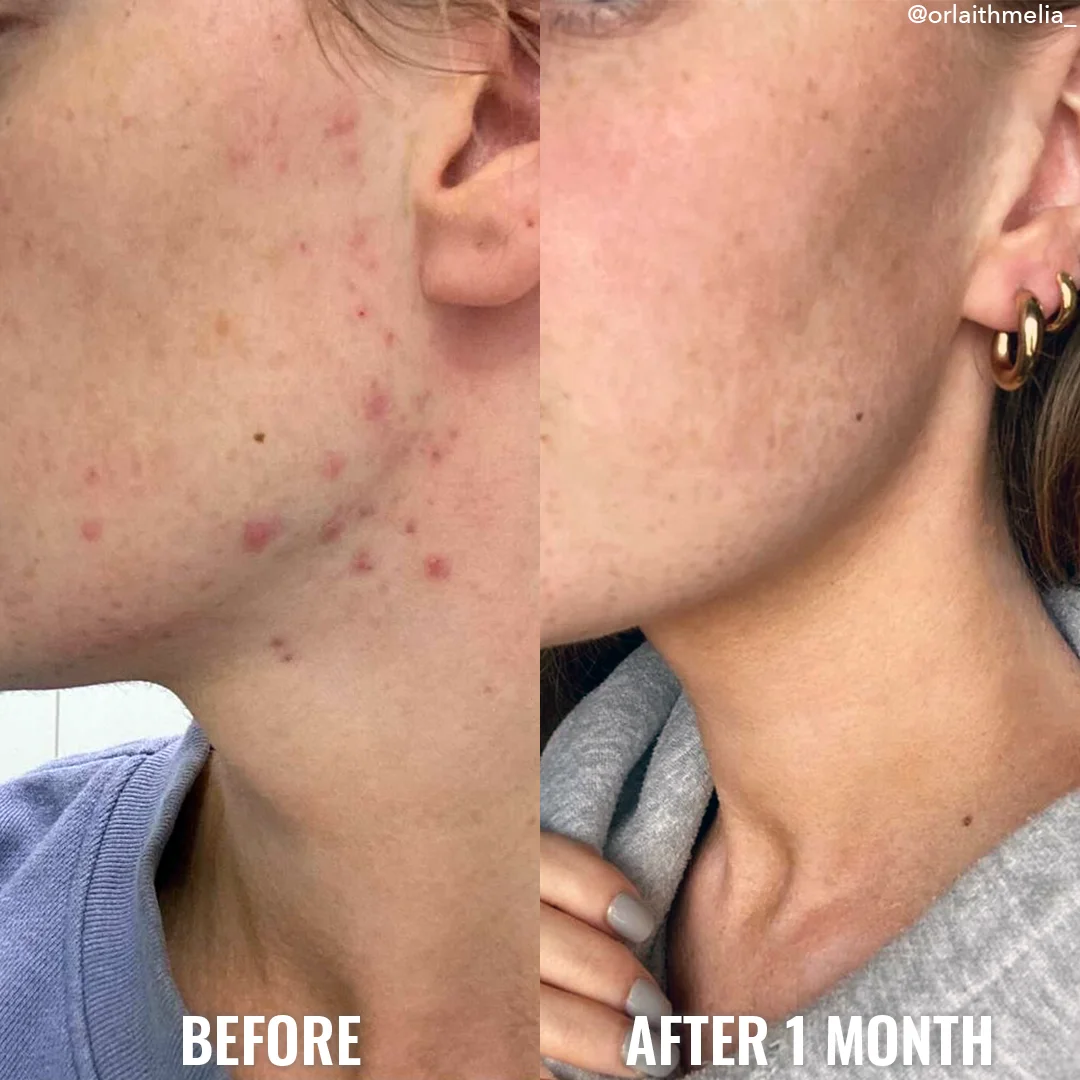 good molecules discoloration correcting Niacinamide brightening facial serum for acne oily dry skin 30ml