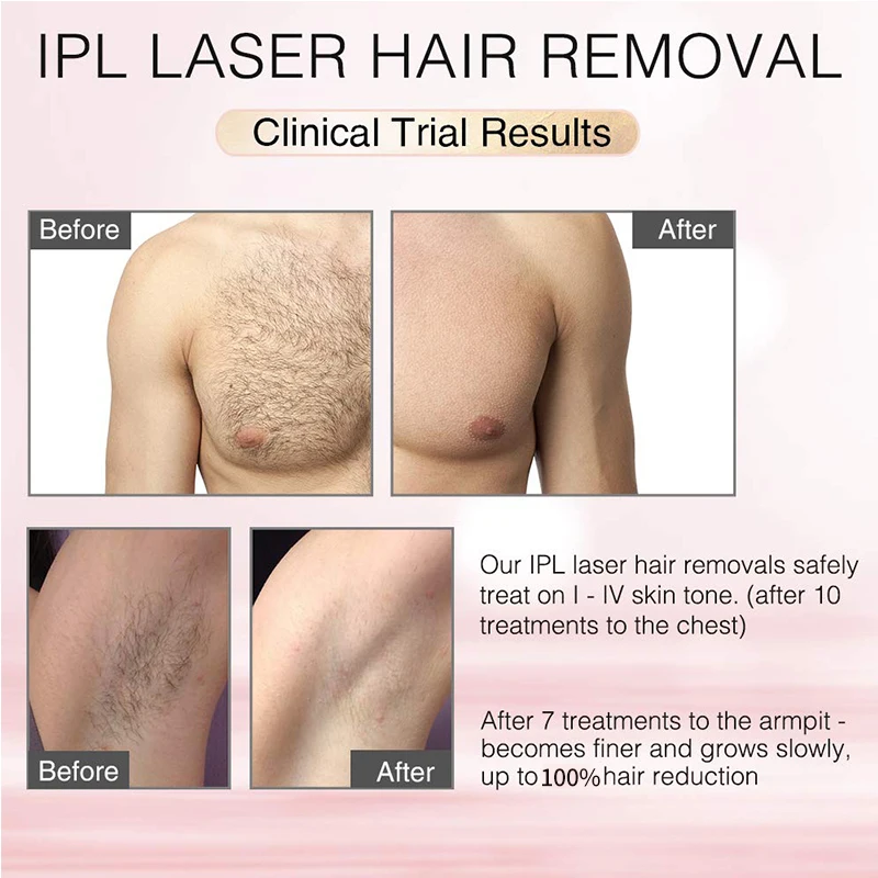 Economical Custom Design Depilation Machine Home Use Ipl Hair Removal Device