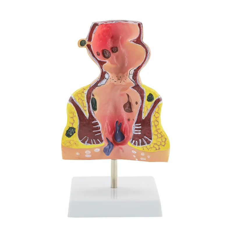 rectal hemorrhoids colorectal disease model Internal and external rectal hemorrhoids anorectal model