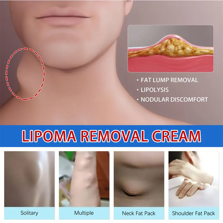 South Moon  Lipoma Cream Relieve  Body lump Treat Benign Lipomas Lipoma Cream