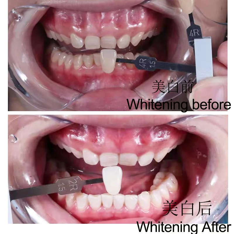 Набор для отбеливания зубов Dr. Whitening Профессиональный гель натуральный отбеливающий аппарата со светодиодной