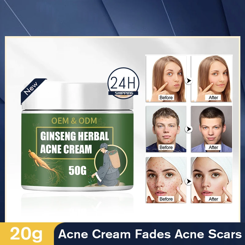 Facial Skin Care vitamin E Cream Anti-Acne  Acne Scar Removal Natural Herbal Extract Herbal Acne Removing Cream