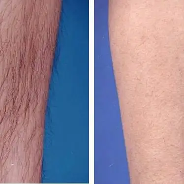 2022 newest 2000W high power professional 808 1064 755 laser hair removal device beauty salon equipment permanent hair removal