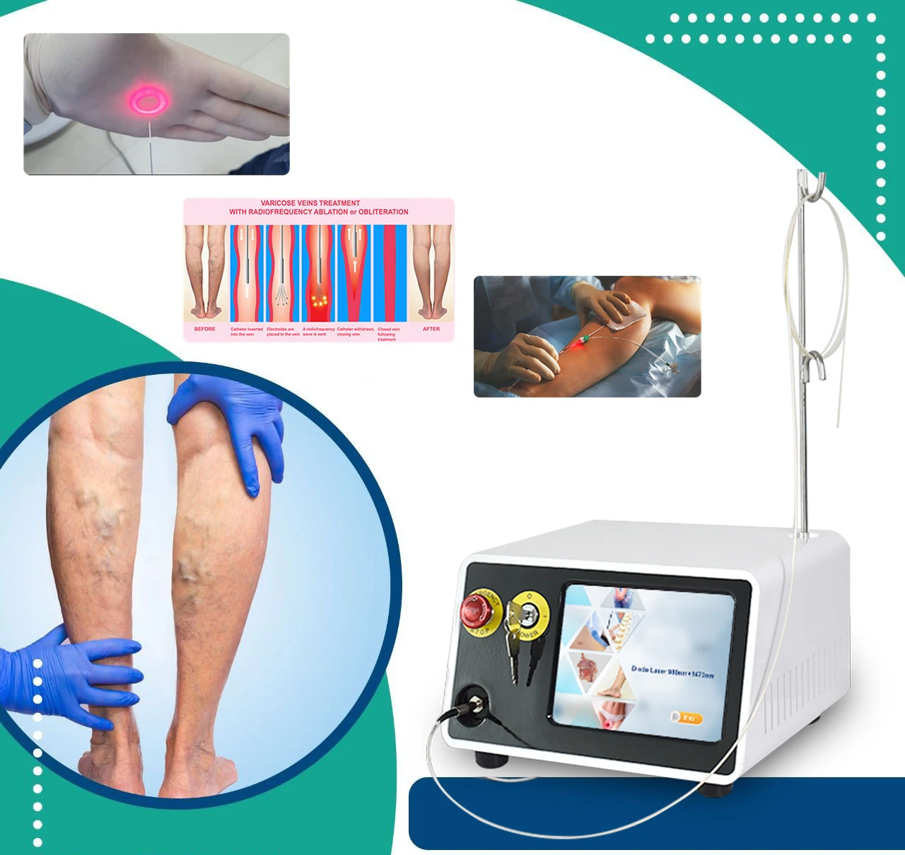 TRIANGEL 980 1470nm Endovenous Laser Varicose Veins Therapy EVLT Endovascular Laser Ablation Clinic Device