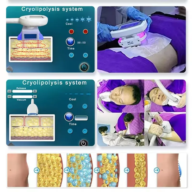 Professional High Quality Cryo Cryotherapy Cool Machine