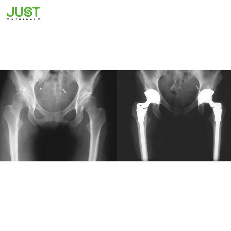 Высококачественные Ортопедические Изделия для искусственных суставов бедер от ASM